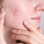 acne scars