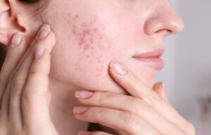 acne scars