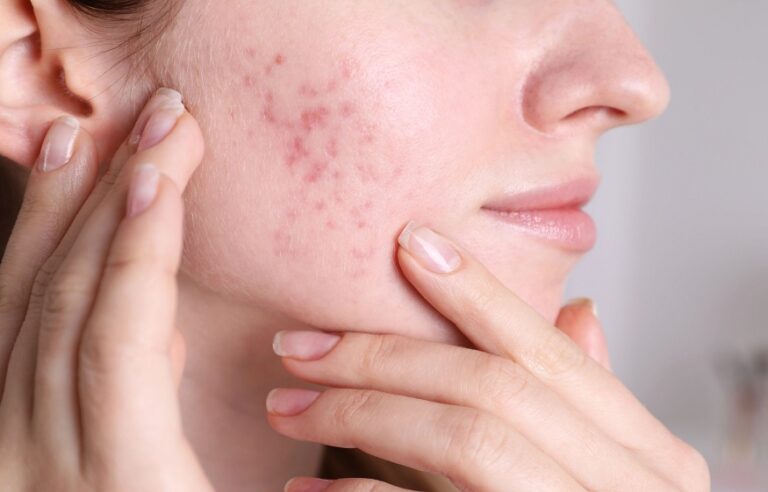 acne scars